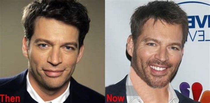 Understanding Harry Connick Jr.'s Scar: A Deep Dive into His Life and Career